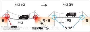 프롤로치료 인대손상