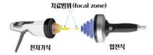 체외충격파 focal zone